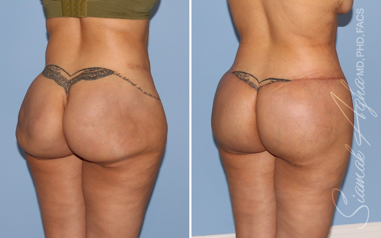 Buttock Correction Before & After