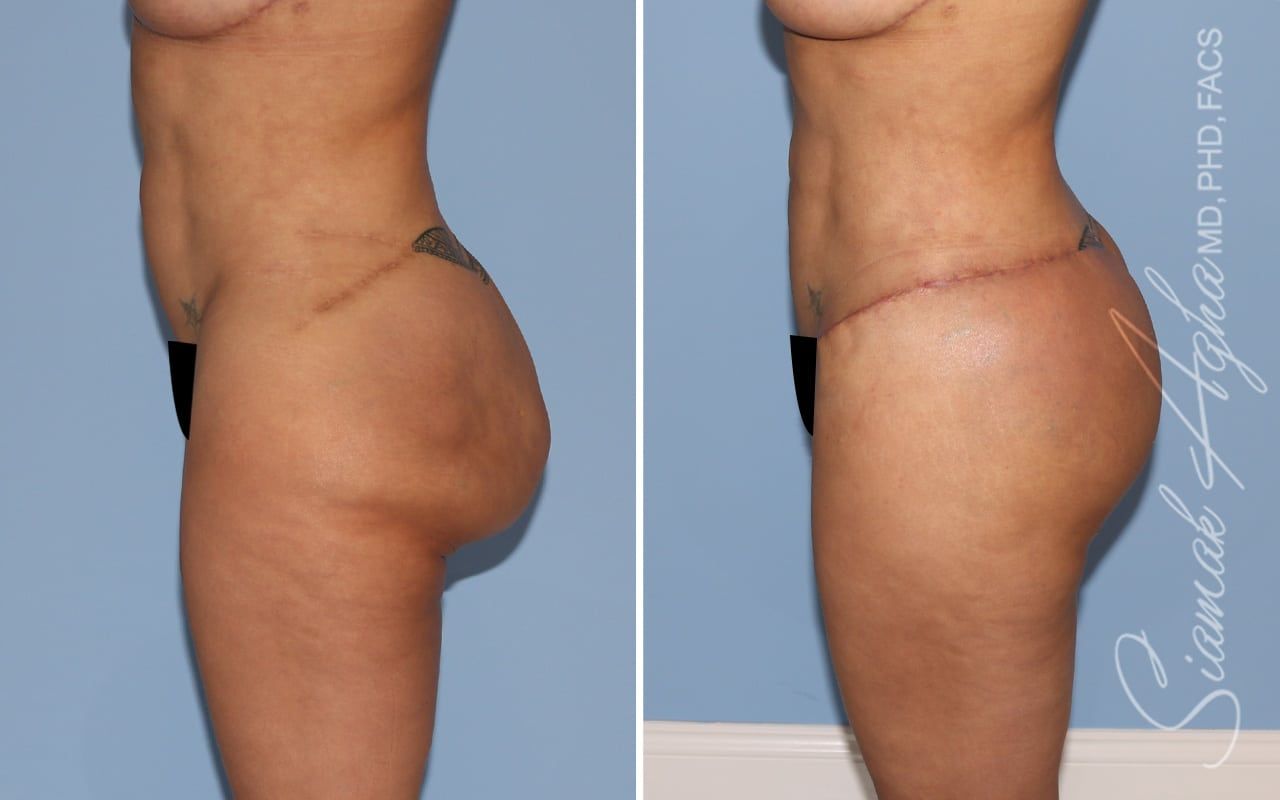 Buttock Correction Before & After