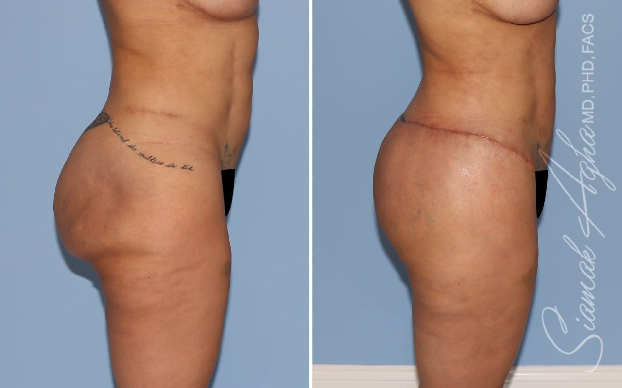 Buttock Correction Before & After