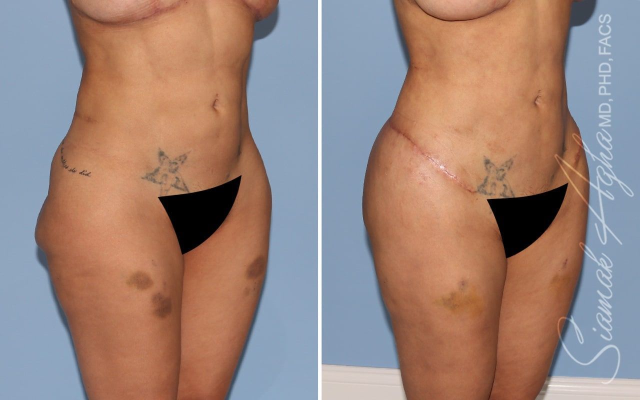 Buttock Correction Before & After