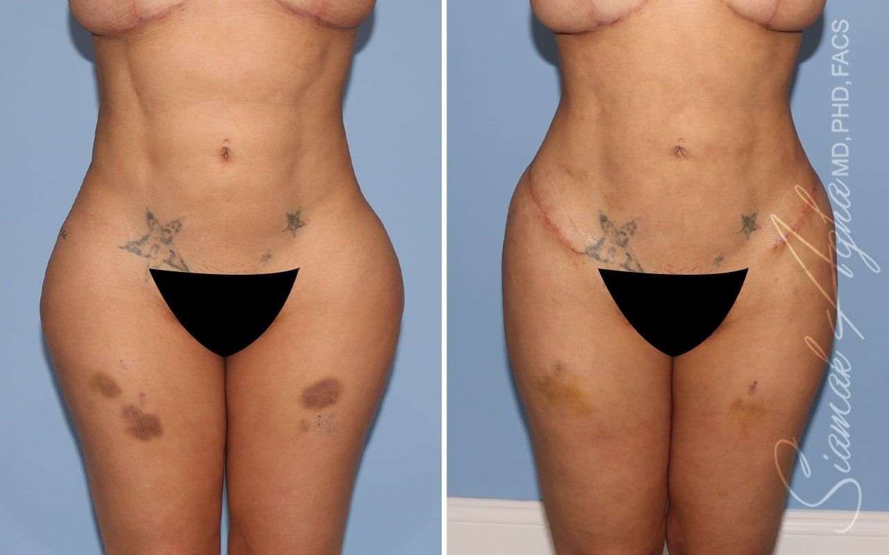 Buttock Correction Before & After