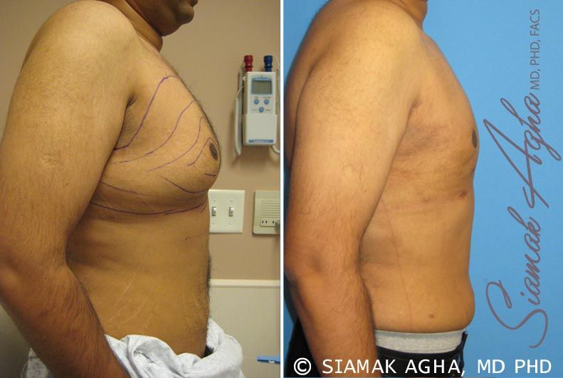 Liposuction Before & After