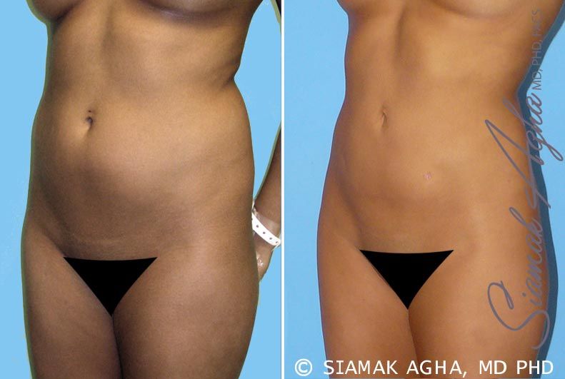 Liposuction Before & After
