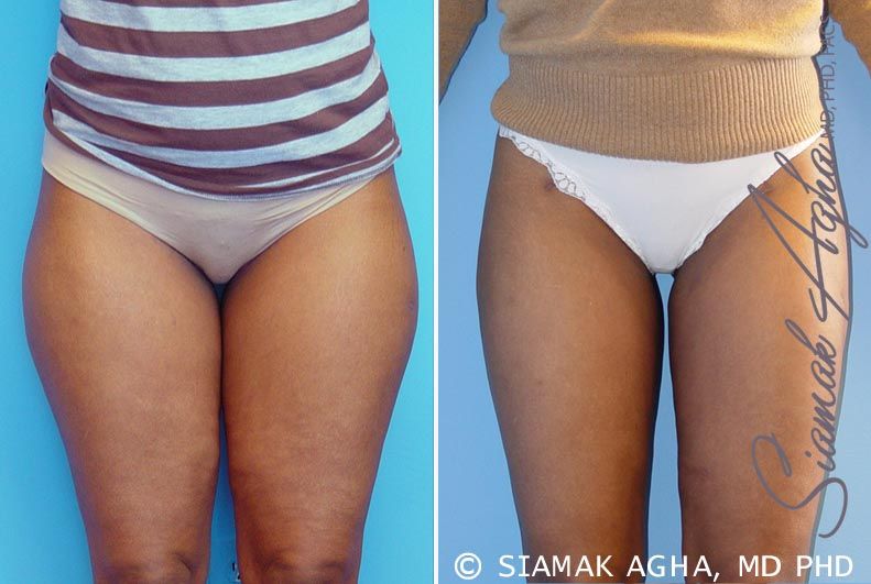 Liposuction Before & After