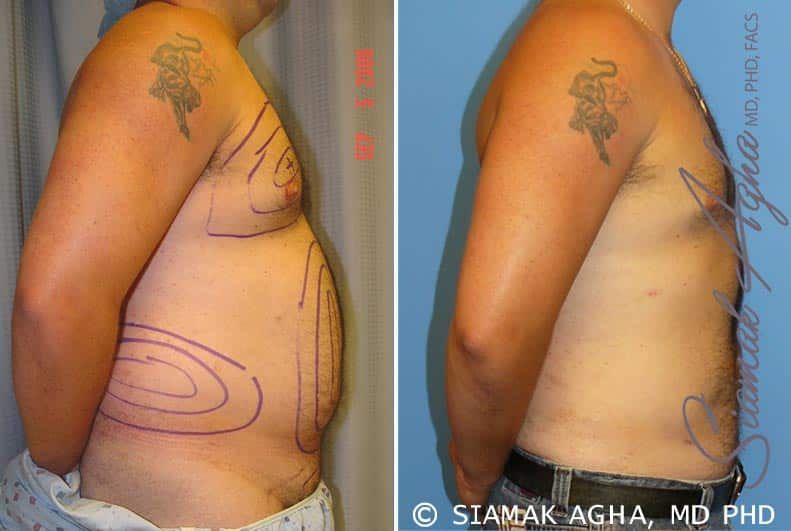 Liposuction Before & After