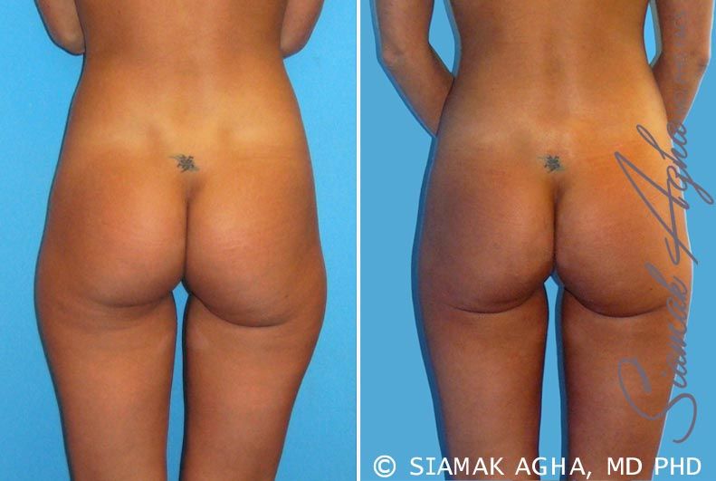 Liposuction Before & After