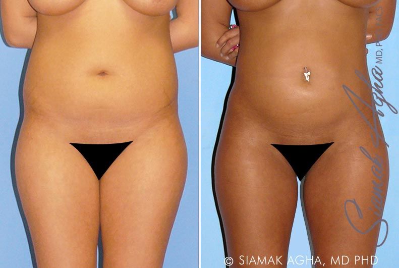 Liposuction Before & After