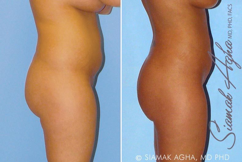 Liposuction Before & After