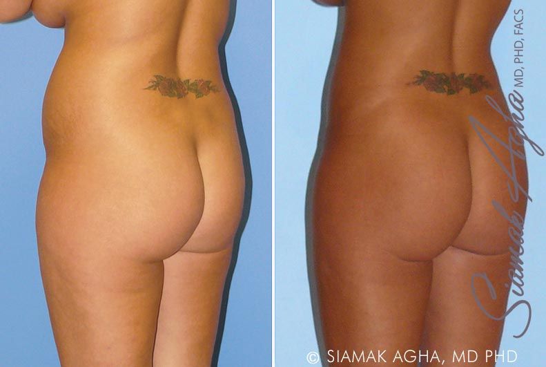 Liposuction Before & After