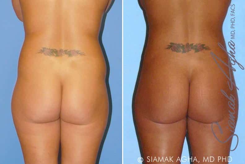 Liposuction Before & After