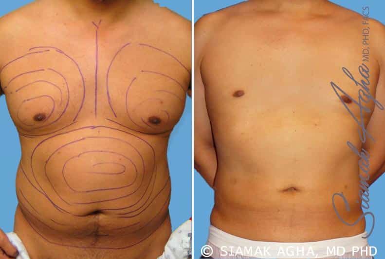 Liposuction Before & After