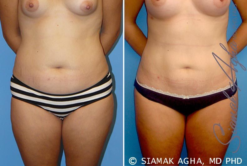 Liposuction Before & After