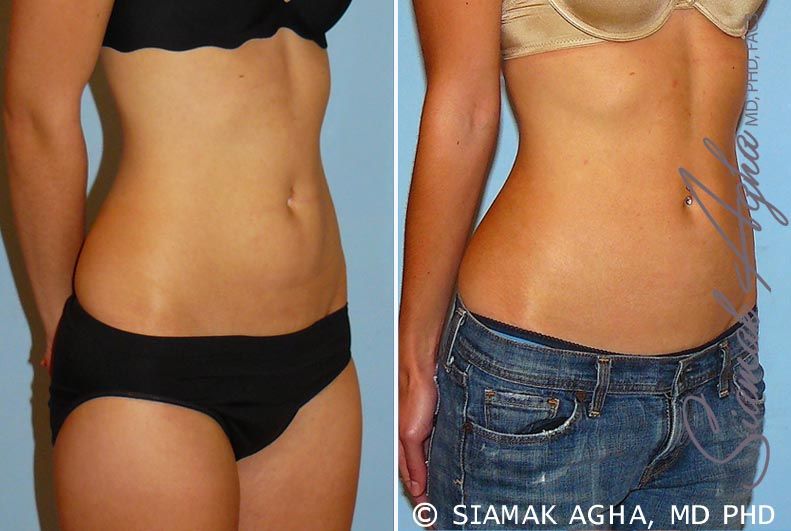 Liposuction Before & After