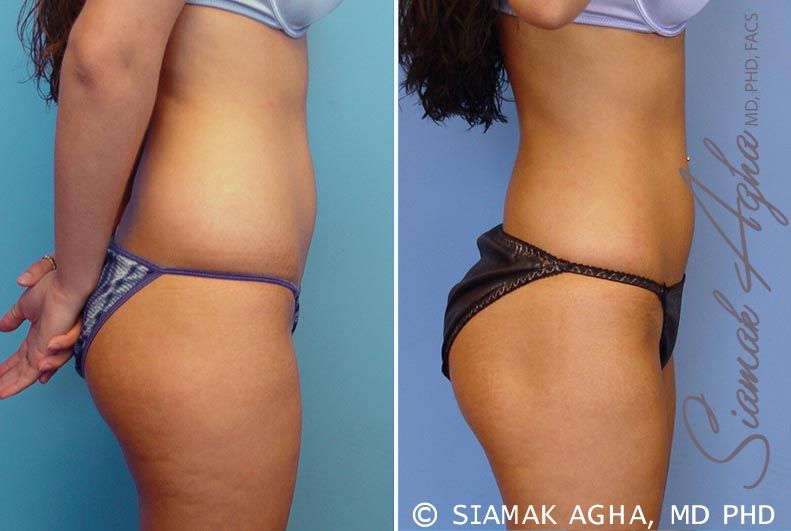 Liposuction Before & After