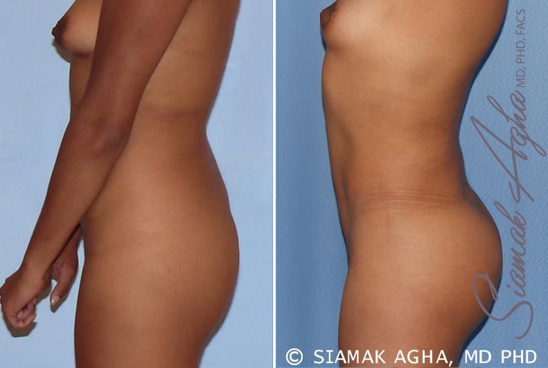 Liposuction Before & After