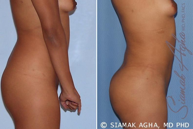 Liposuction Before & After