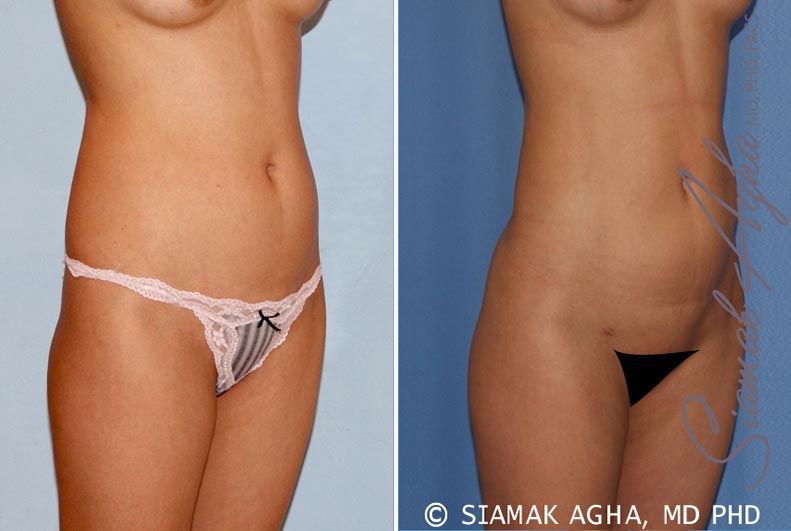 Liposuction Before & After