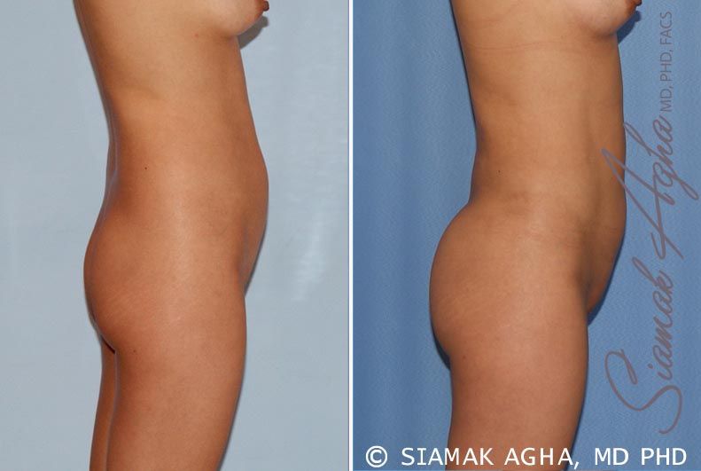 Liposuction Before & After