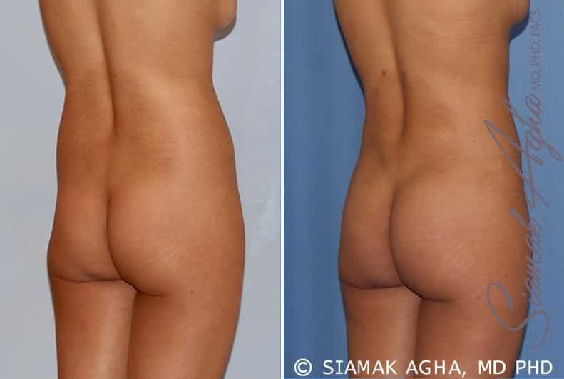 Liposuction Before & After