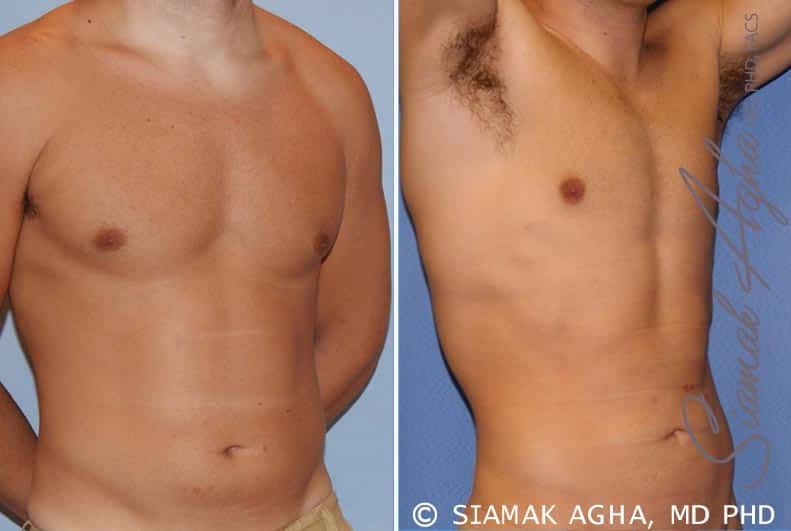 Liposuction Before & After
