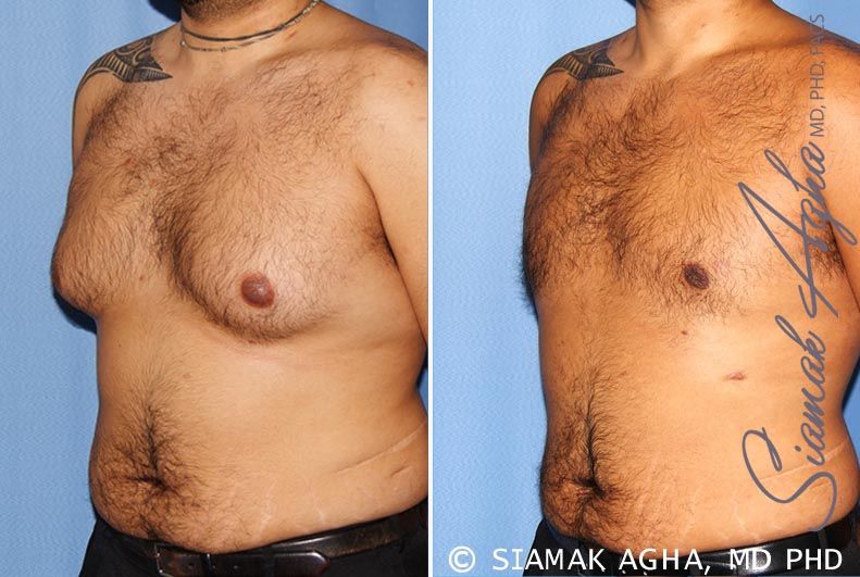 Liposuction Before & After