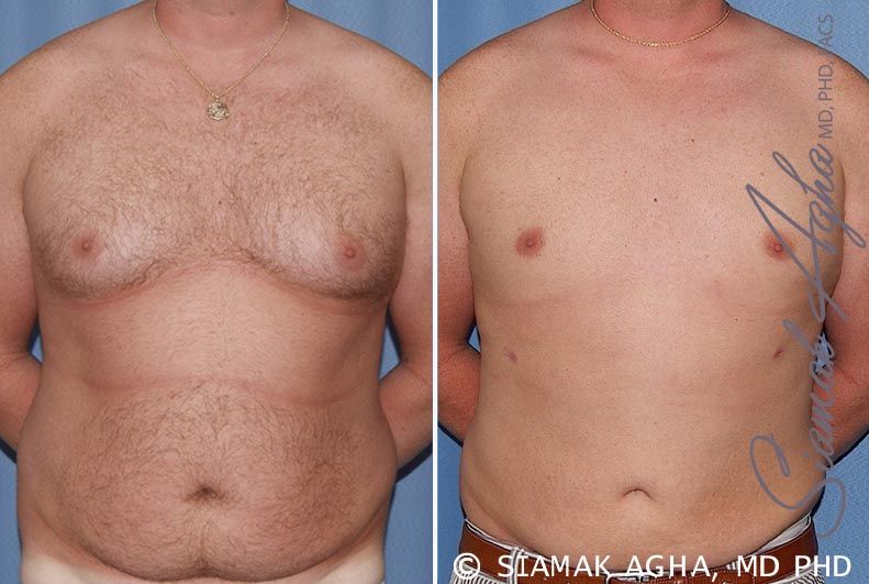 Liposuction Before & After
