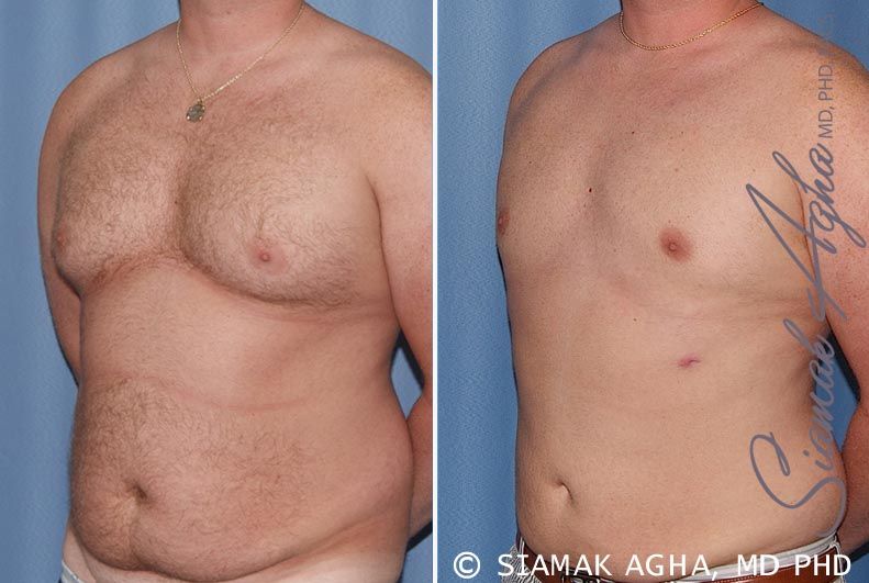 Liposuction Before & After
