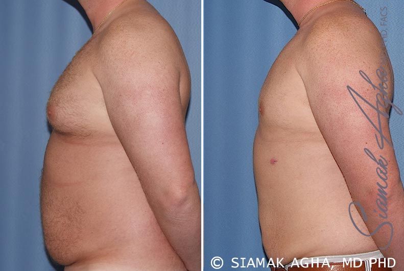 Liposuction Before & After