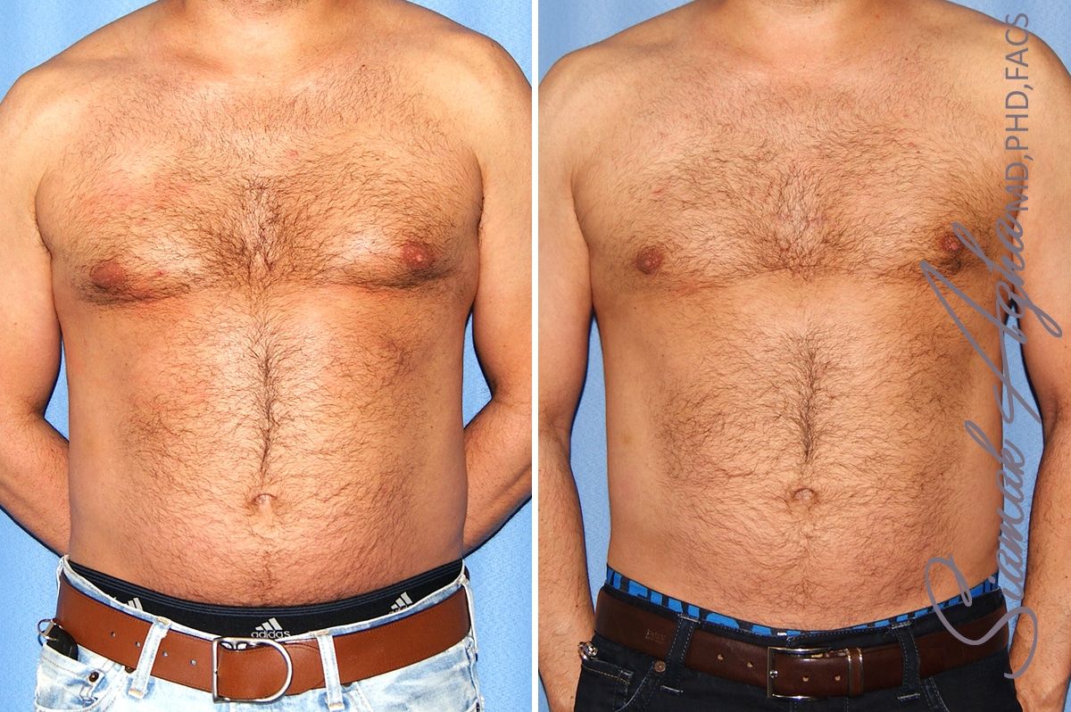 Liposuction Before & After