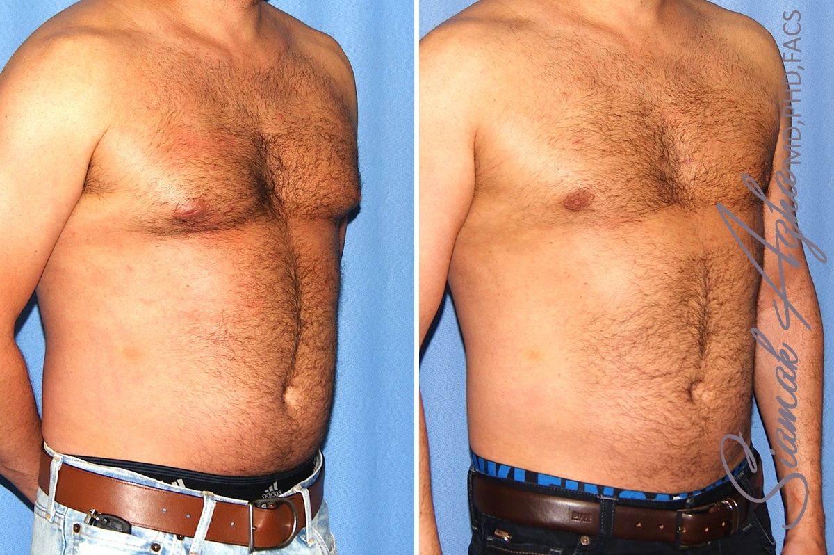Liposuction Before & After
