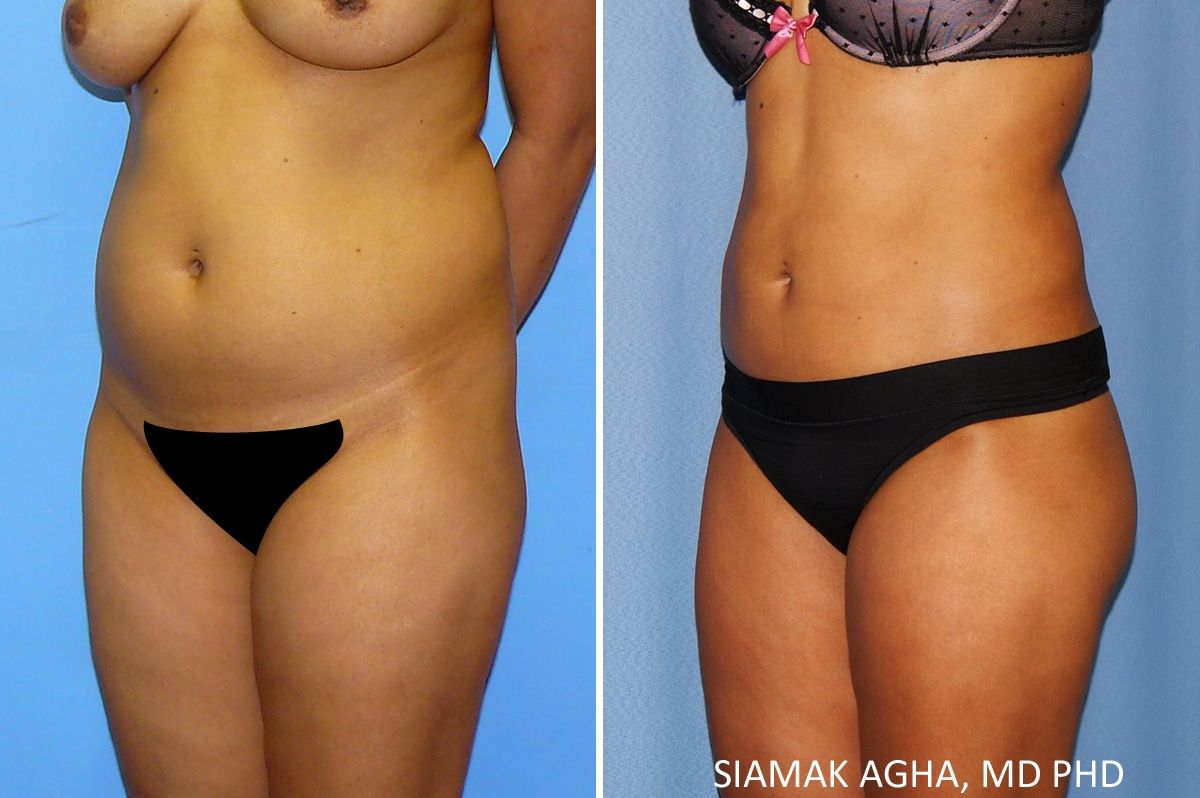 Liposuction Before & After