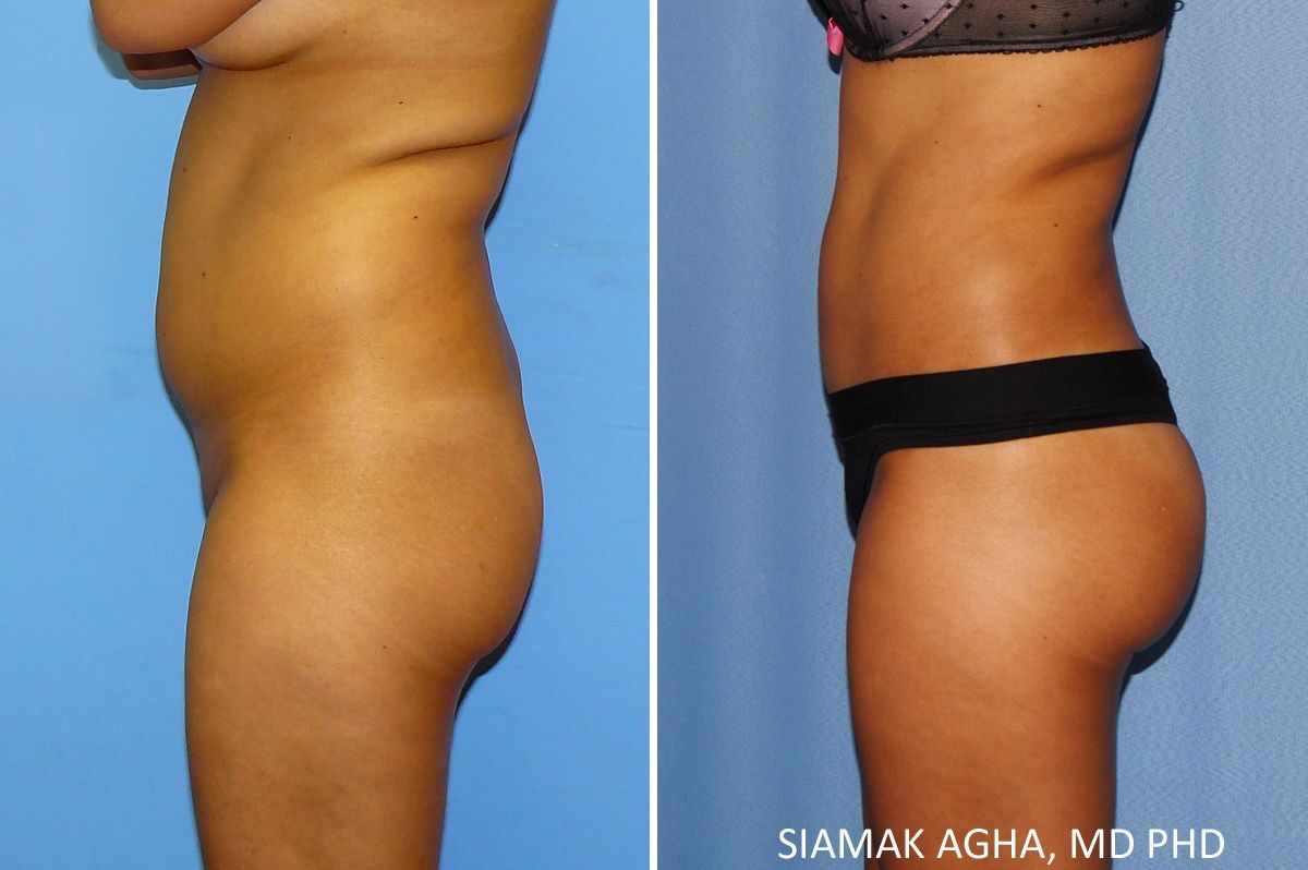 Liposuction Before & After