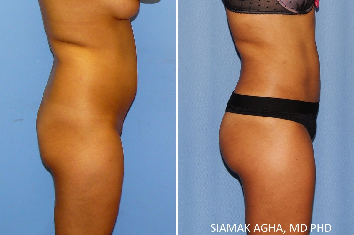Liposuction Before & After