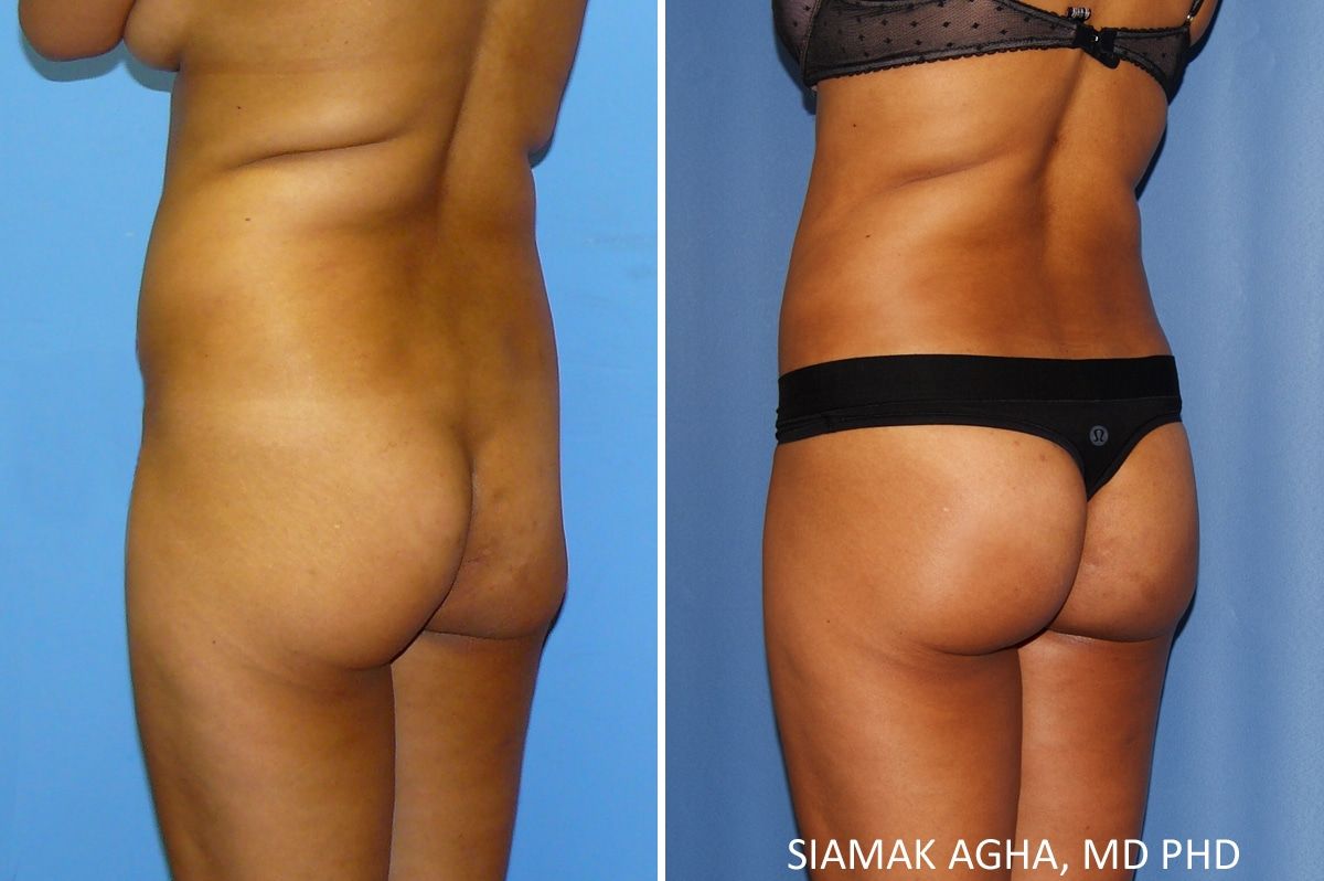 Liposuction Before & After