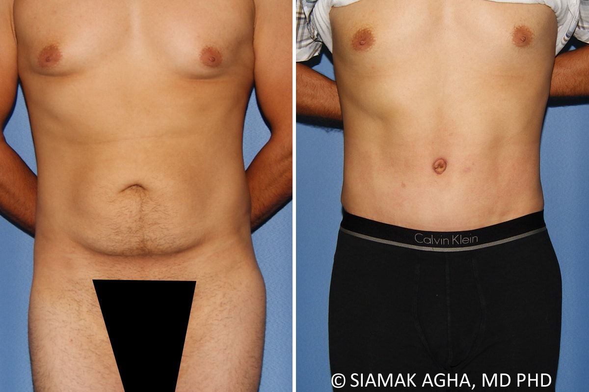 Liposuction Before & After
