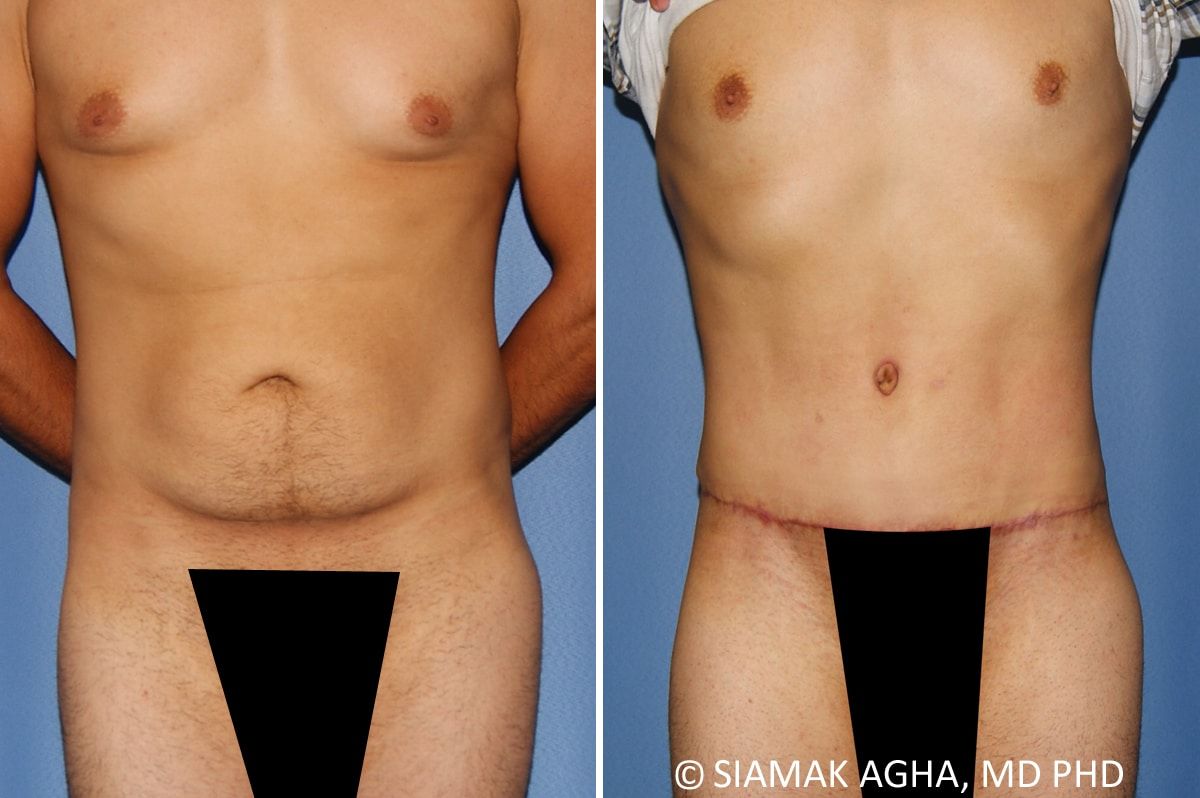 Liposuction Before & After