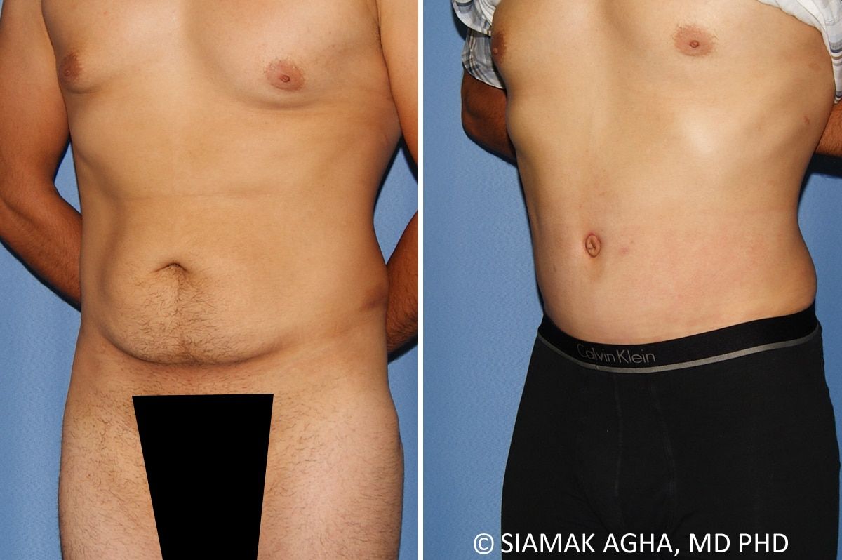 Liposuction Before & After