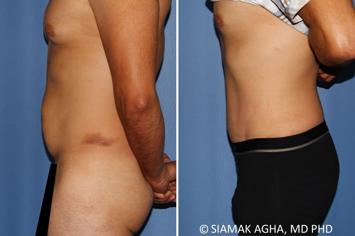 Liposuction Before & After