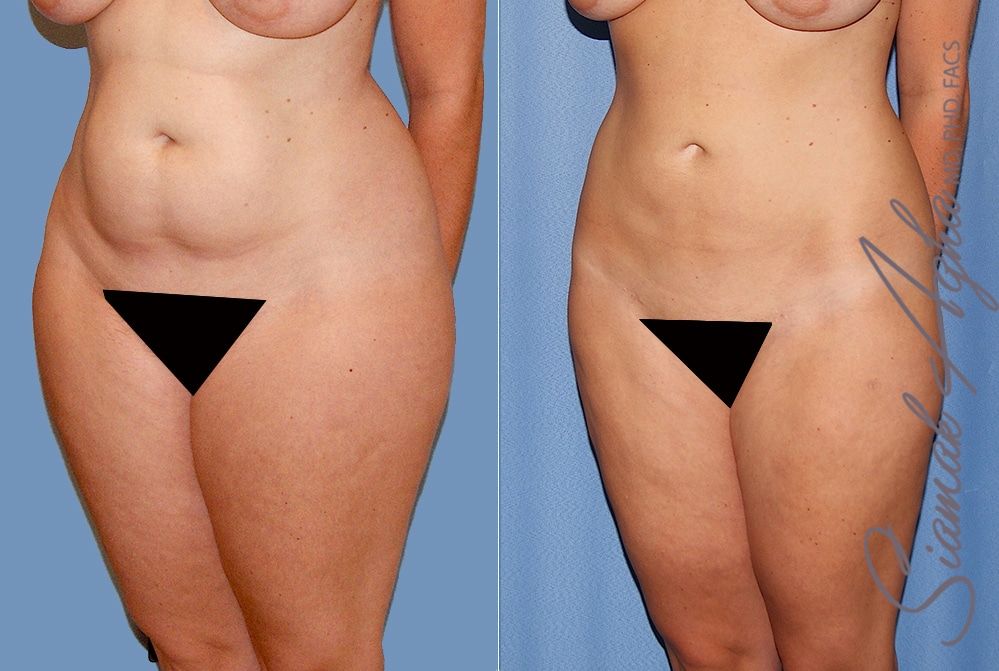 Liposuction Before & After