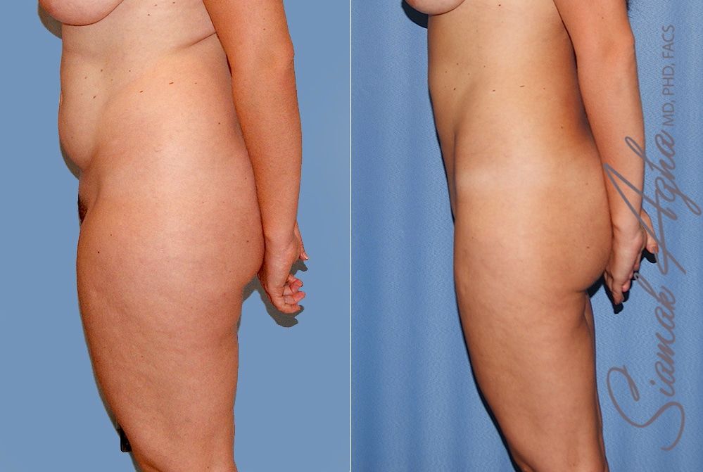 Liposuction Before & After