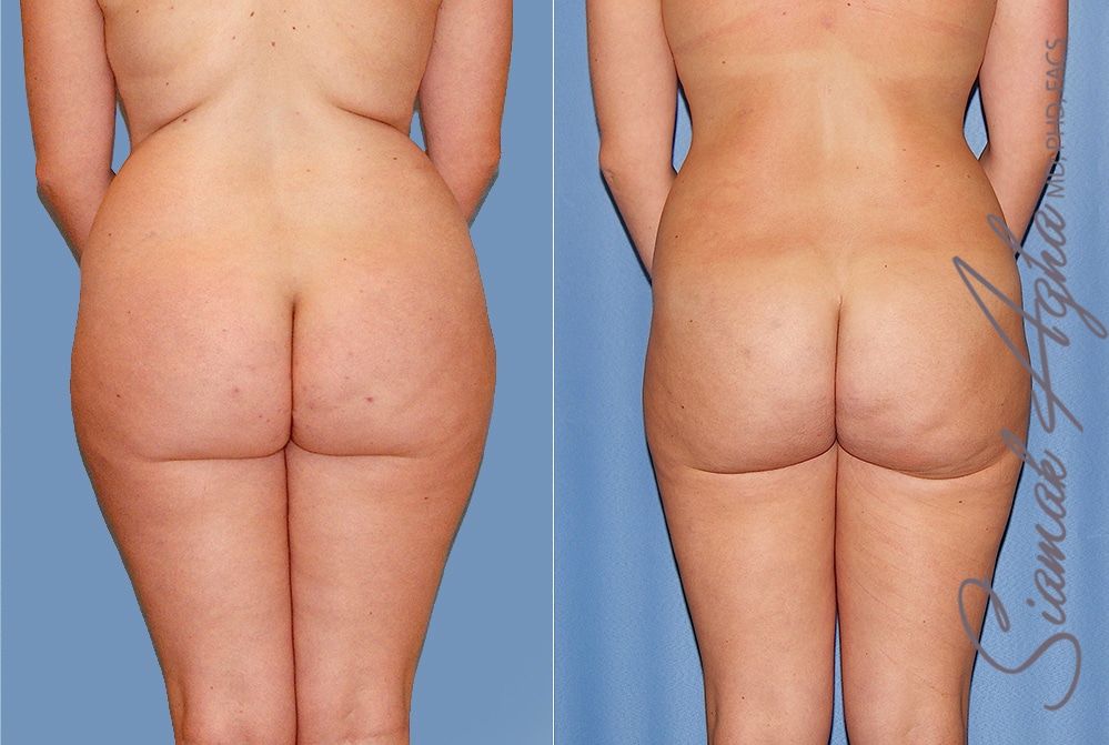 Liposuction Before & After