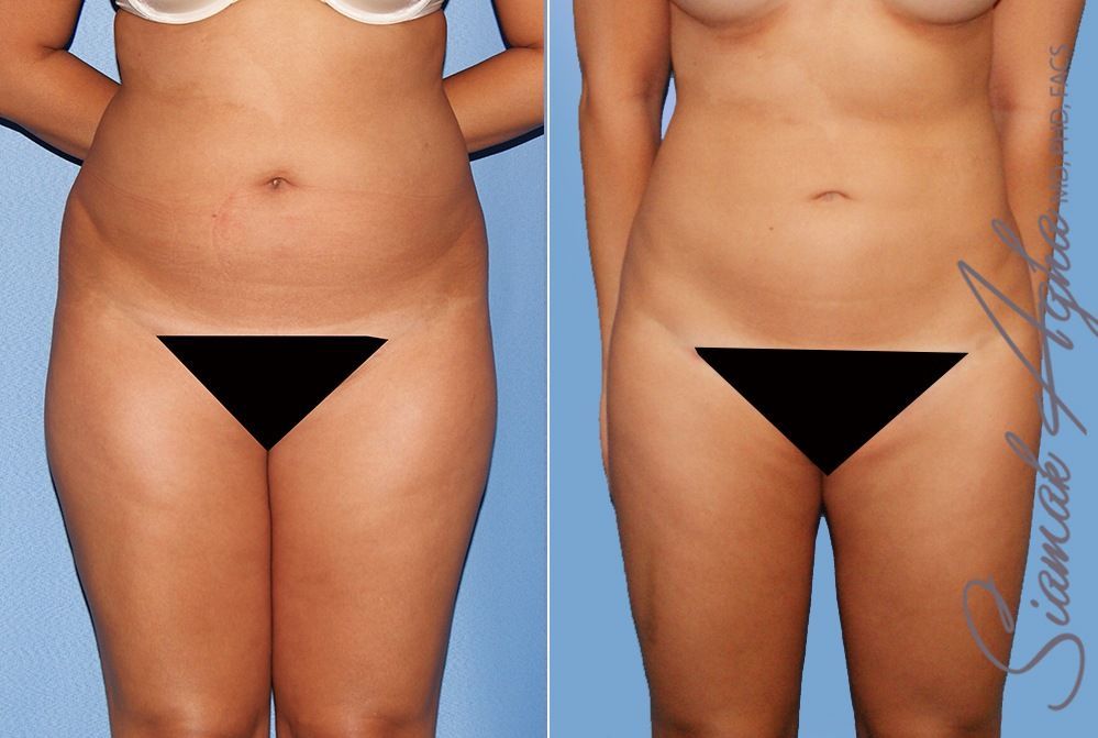 Liposuction Before & After
