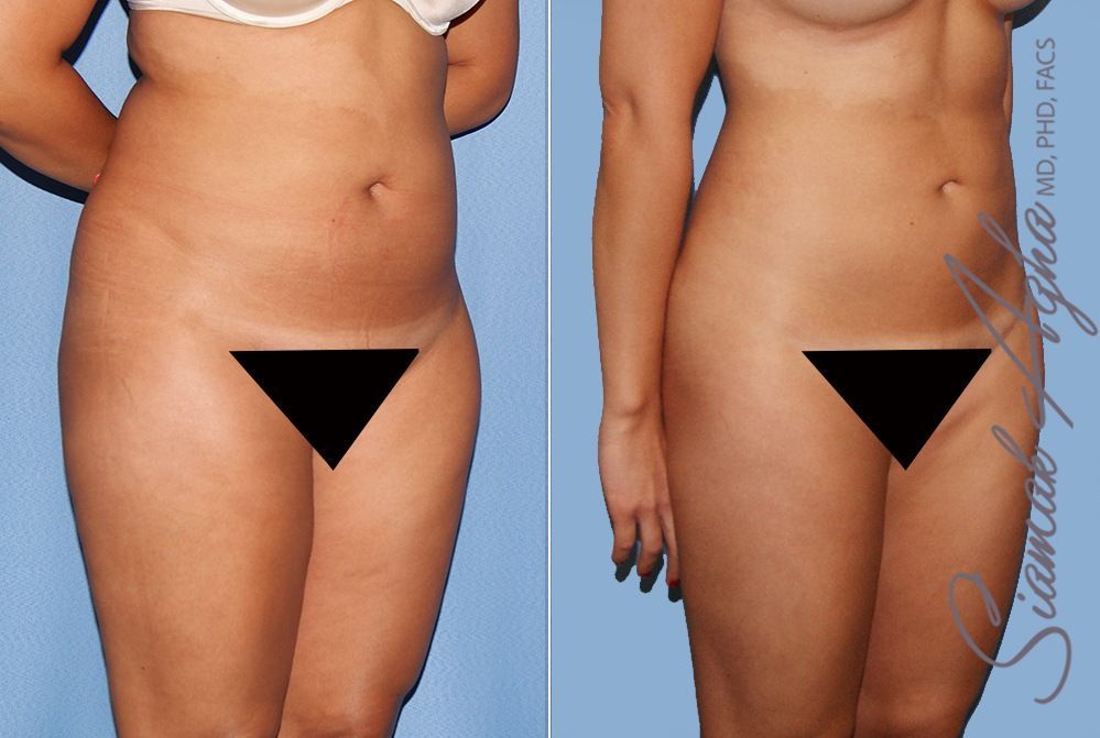 Liposuction Before & After