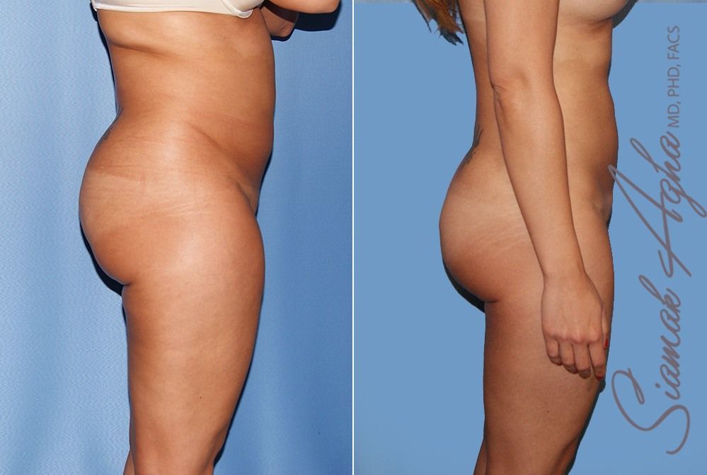 Liposuction Before & After