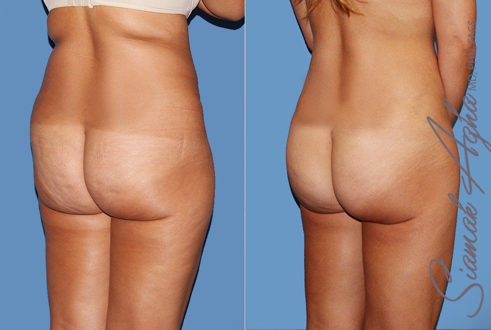 Liposuction Before & After