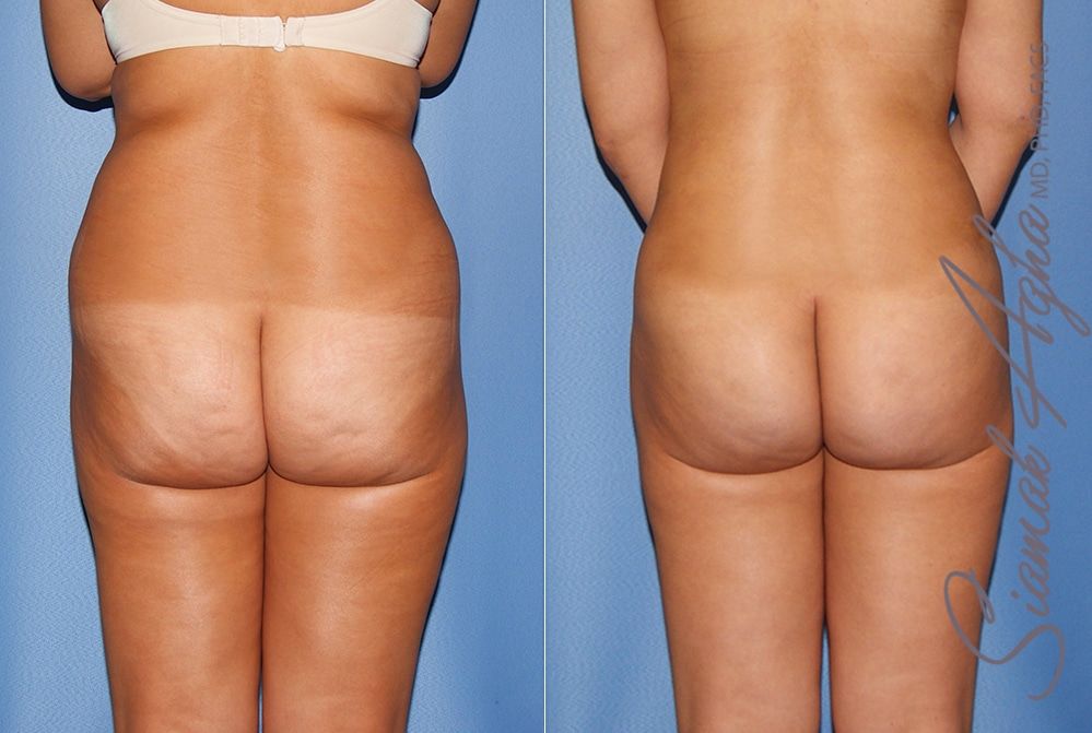 Liposuction Before & After