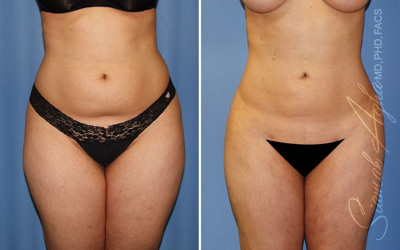 Liposuction Before & After