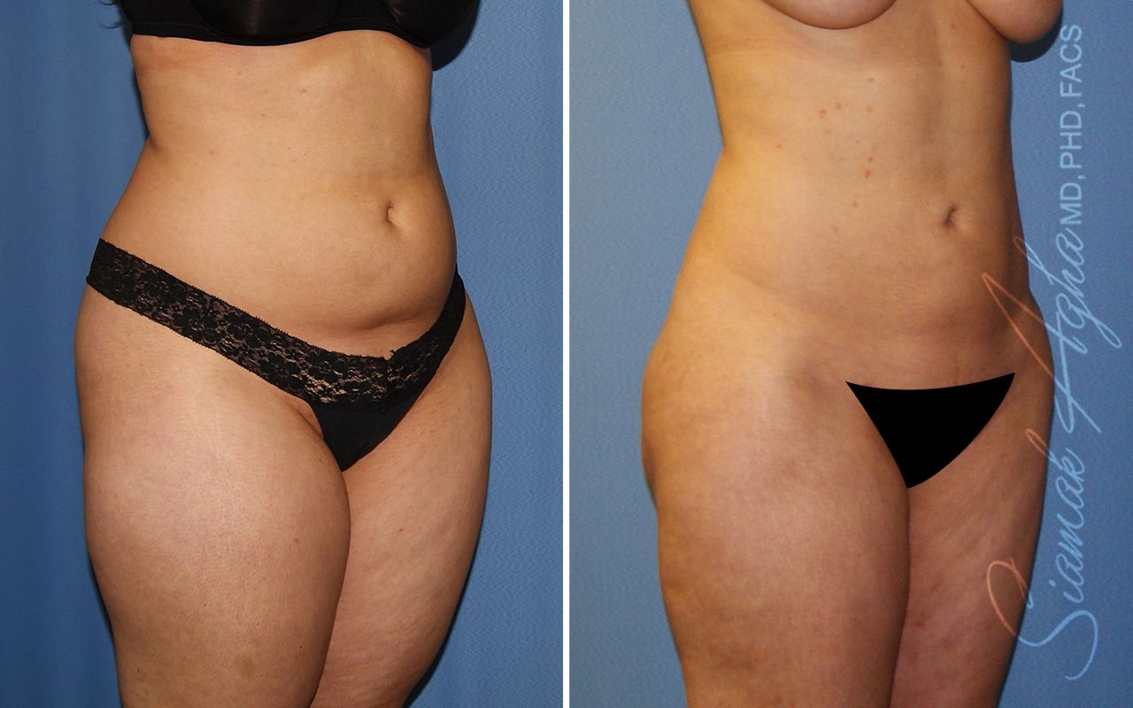 Liposuction Before & After