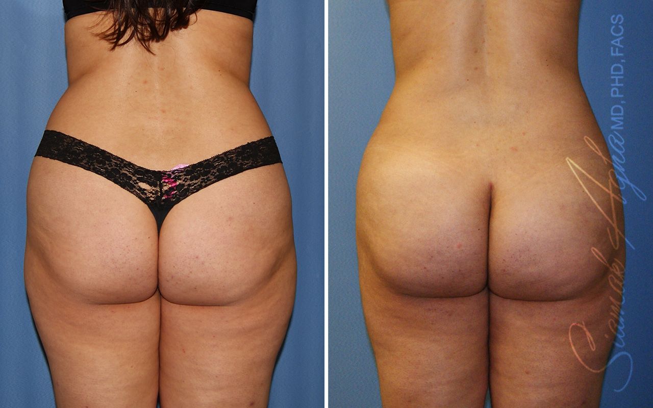 Liposuction Before & After