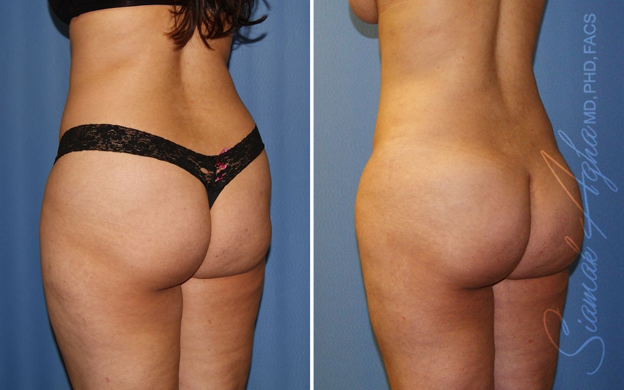 Liposuction Before & After